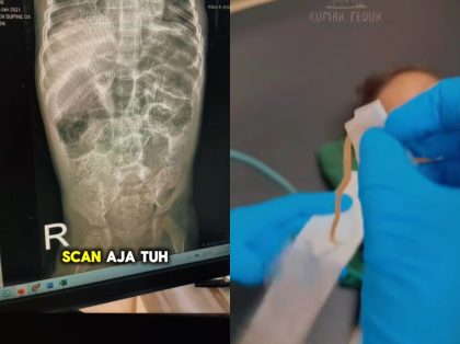 Balita Sukabumi meninggal 1 kg cacing ditemukan di tubuhnya